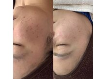 ディアー 原宿(Diar)/肌荒れでお悩みのお客様の症例