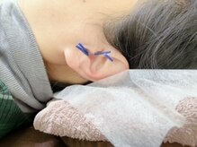 ヘルシースリムウエダ/耳つぼダイエット鍼