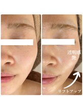 エース(ACE.)/美容液導入♪