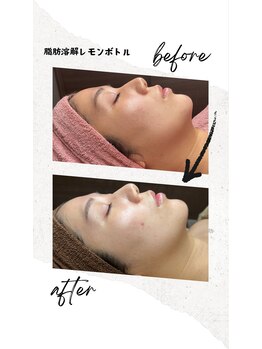 ベル(Belle)/脂肪分解レモンボトル