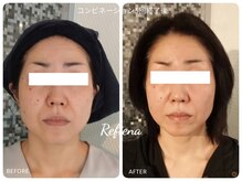 クリニカルエステ リフィーナ 西荻窪店/コンビネーション