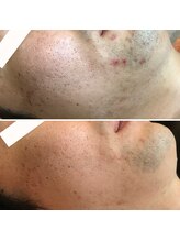 ヴィヴィ(ViVi)/男性も♪HAAB REPRO ピーリング