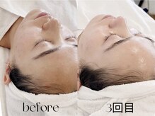 シュリ(Shri)/韓国エステでつやんつやん