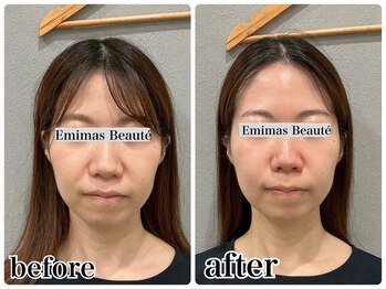 エミマス ボーテ(Emimas Beaute’)/小顔矯正＆毛穴洗浄でたるみケア