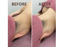 ベルミーランド MEGAドン・キホーテ草加の雰囲気(えり足肩脱毛初回)