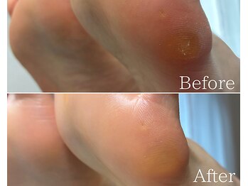 カシェット 広島店(Cachette)/20代女性☆足裏角質ケア90分