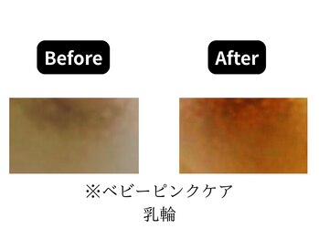 モンロー(MonroE+)/黒ずみ・くすみ・色素ケア