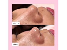 ホワイトラボ 新潟万代(White labo)の雰囲気（毛穴洗浄しながら美容成分を補給するハイドロフェイシャル☆）