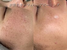 ライリー(Rairy)の雰囲気（【シミ・赤み・肌荒れ】次世代ダーマ+ハーブピーリング）