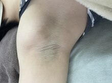 ナノハナ/鹿沼市全身脱毛美容室ナノハナ