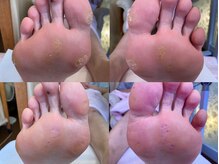 ビサンテ サロン/角質ケアで魚の目のお悩み解消！