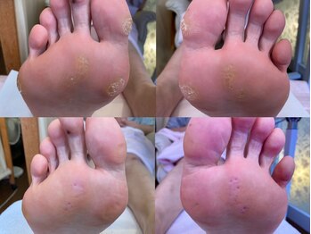 ビサンテ サロン/角質ケアで魚の目のお悩み解消!