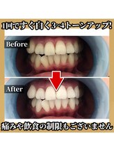 トワ 大宮(TOWA)/～セルフホワイトニング・症例～