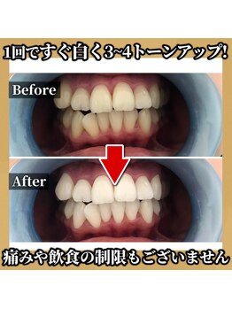 トワ 大宮(TOWA)/~セルフホワイトニング・症例~