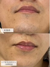 みんなのLED脱毛/30代前半男性・ひげ脱毛