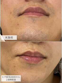 みんなのLED脱毛/30代前半男性・ひげ脱毛