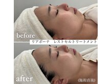 ミエル 神戸店(Miel)/レストセルトリートメント