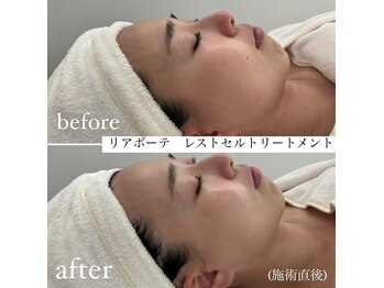 ミエル 神戸店(Miel)/レストセルトリートメント