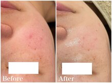 サロンドフェイス(Salon de Faith)/【ハーブピーリング】4回施術♪