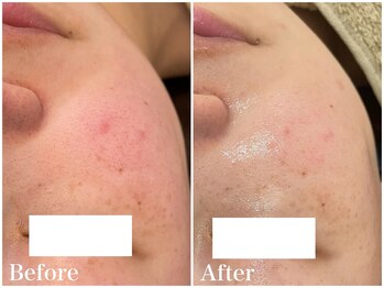 サロンドフェイス(Salon de Faith)/【ハーブピーリング】4回施術♪