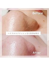 ブライトサロン(Bright Salon)/ごっそり！毛穴洗浄