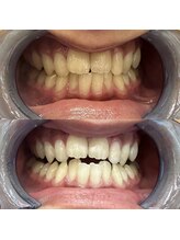 エール(aile)/うるま市セルフホワイトニング