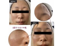 ヴィクトリアの雰囲気（大人気のソフトピーリング！肌触りが変わってきます）