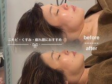 ソワン ド ブランシュ ライフ八戸ノ里店(Soin de Blanche)/くすみ・むくみ・たるみに◎