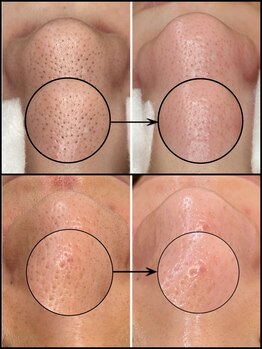 毛穴専科/毛穴洗浄で毛穴ツルツル♪