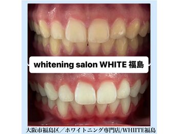 ホワイトニングサロン ホワイト(WHITE)/セルフホワイトニング/大阪/福島