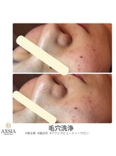 アクシア ビューティー サロン(AXSIA)/毛穴洗浄【before after】