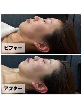 ほねつぎ 平成けやき通り鍼灸接骨院/πテラピー ビフォー/アフター3