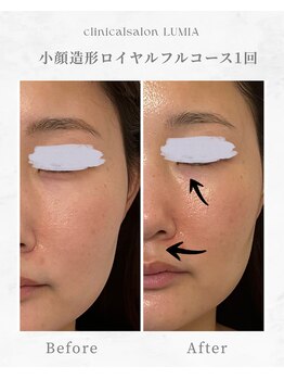 ルミア(LUMIA)/小顔造形ロイヤルフルコース１回
