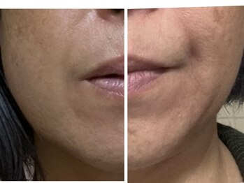 ひびき 京都烏丸御池店/リフトアップで小顔&たるみケア