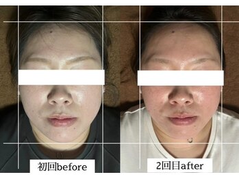 ダイアリー(DIARY)/小顔矯正