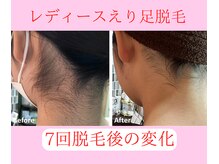 グロワール(gloire)/レディースえり足BeforeAfter