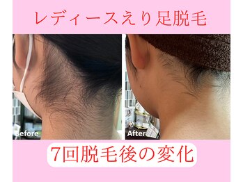 グロワール(gloire)/レディースえり足BeforeAfter