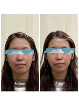 ハリ トモカ 南浦和サロン(HARI TOMOKA)/美容鍼