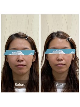 ハリ トモカ 南浦和サロン(HARI TOMOKA)/美容鍼