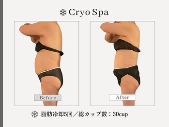 クリオスパ せんげん台駅前店(Cryo Spa)/脂肪冷却