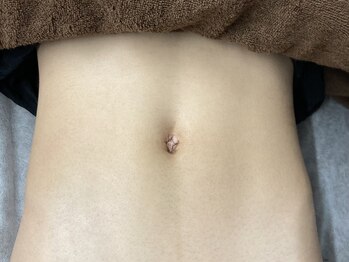 ヴィプラス(VIPLUZ)/ギャランドウ脱毛