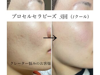 テテメルティ(te-te melty)/凸凹肌のお悩み改善