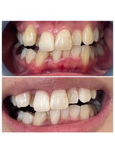 ウルト(ULT)/セルフホワイトニング