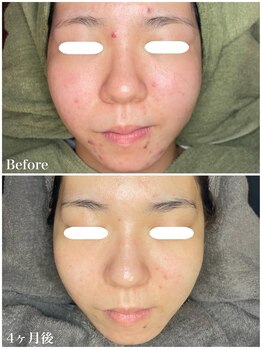 ちらちゅら/クリスティーナ＋毛穴洗浄