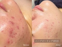 ラティエ(Latier)/3ヶ月でこのお肌変化！！