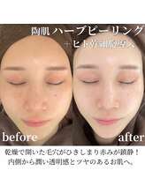 エムラボ 麻布十番店(M LABO)/ハーブピーリングヒト幹細胞導入