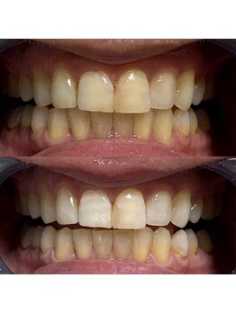 Grace Whitening Yokohama/40分照射＋水素吸引