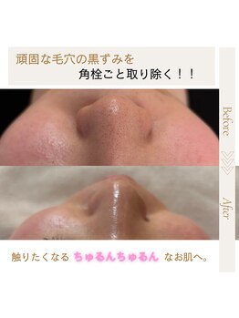 ラ トゥール(La tour)の写真/【頑固な毛穴悩みを根本解消】 毛穴の黒ずみ・開きを徹底ケア◎驚きのトーンアップと艶肌へ♪