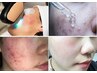 【ニキビ専門ケア】最新プラズマ美容で赤み、荒れを治癒して凹凸ケア、肌修正