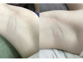 ナノハナ/鹿沼市全身脱毛美容室ナノハナ